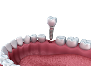 dental implant in Clapham