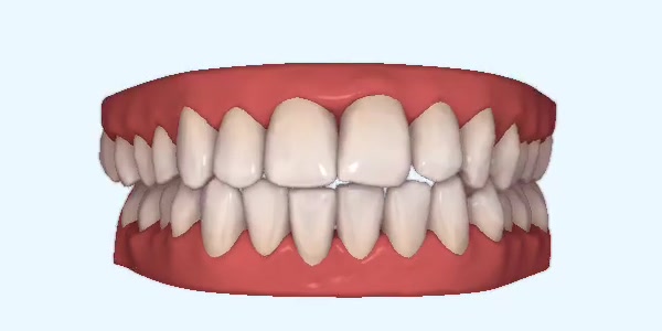 Fixed Ceramic Braces Southend on Sea