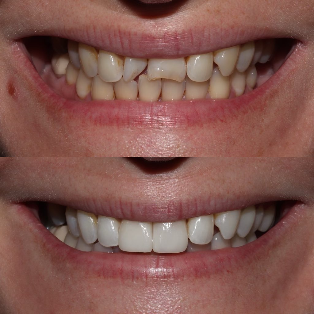 Before and After