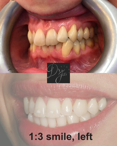 Before After