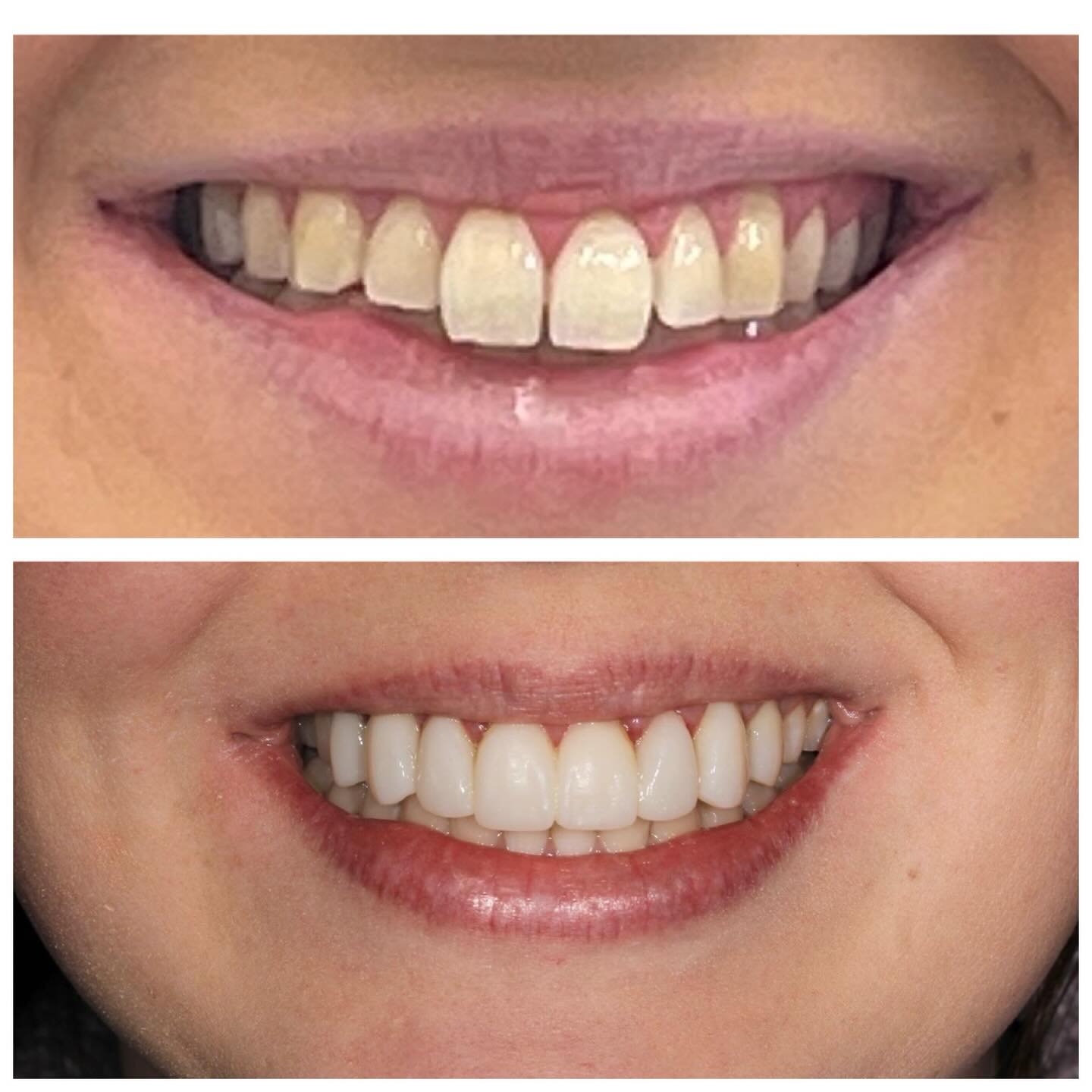 Before and After