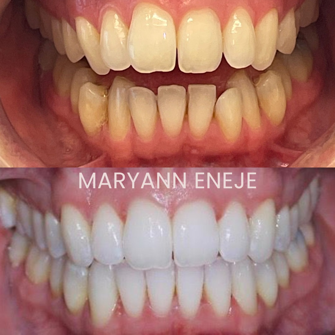 Before and After