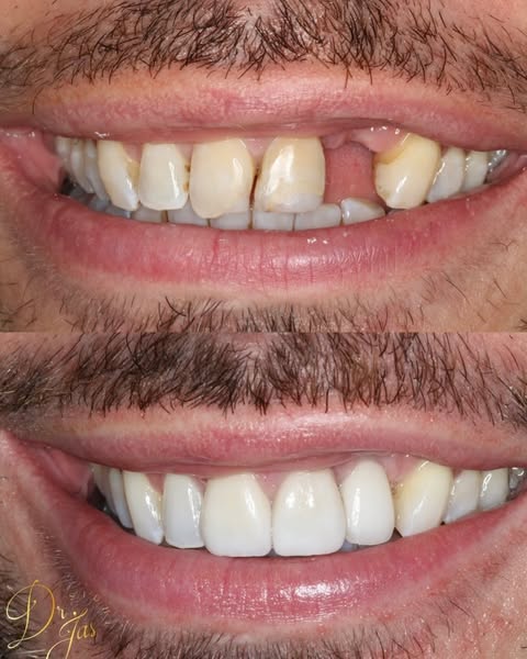 Before and After