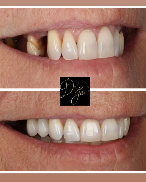 Before and After