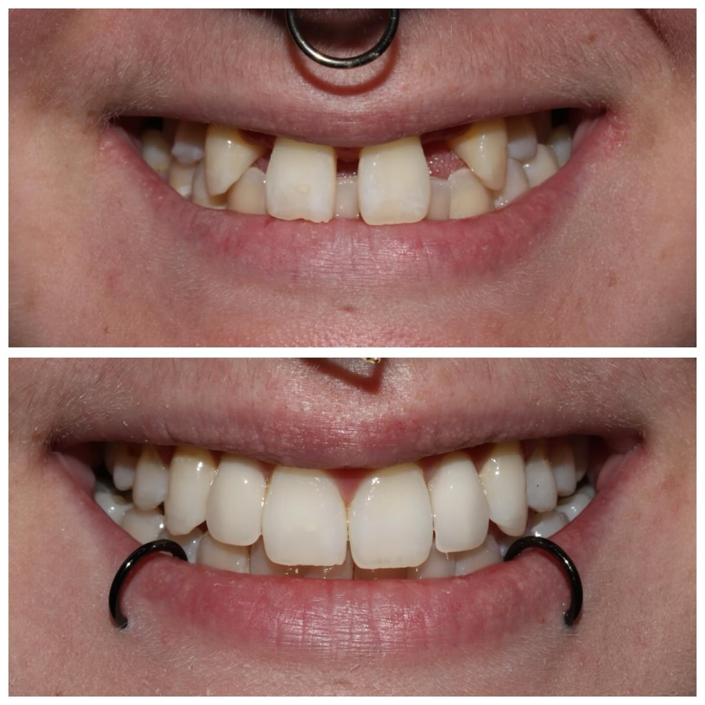 Before and After