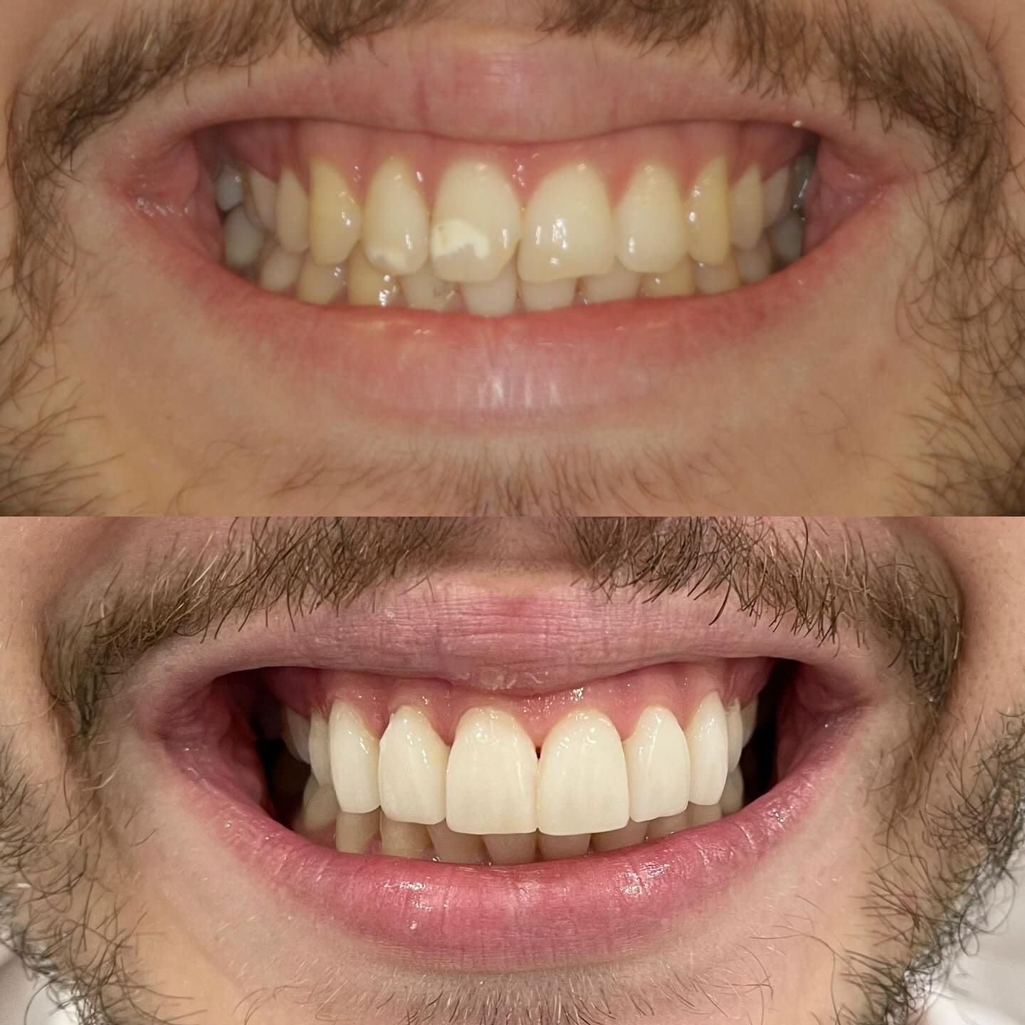 Before and After