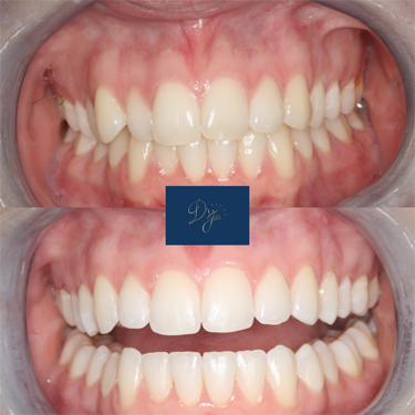 Invisalign and Whitening