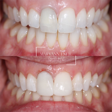 Composite Bonding to hide crack lines and discolouration