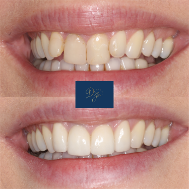 Veneers, Crowns and Whitening