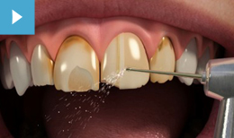 Porcelain Veneers