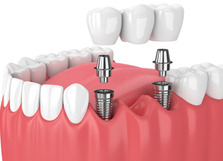 implant supported bridge in Clapham